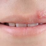 Rasche Hilfe bei Lippenherpes